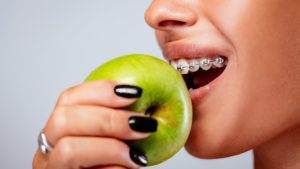 The Complete Guide to Foods You Can’t Eat with Braces