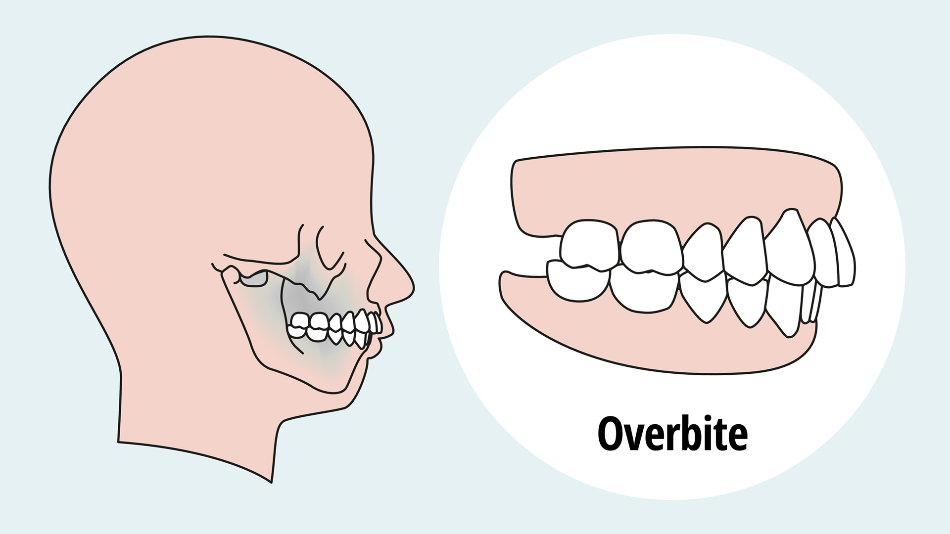 Overbite Correction Techniques Your Complete Guide Overbite Correction Techniques Your Complete Guide