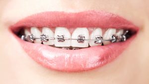 Using Your HSA for Braces